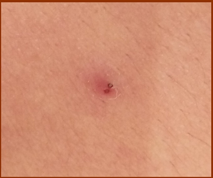 Scar of a puncture wound